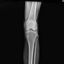 Osteopenia