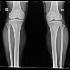 Osteopenia