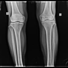 Osteoporosis