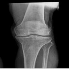 Osteoporosis